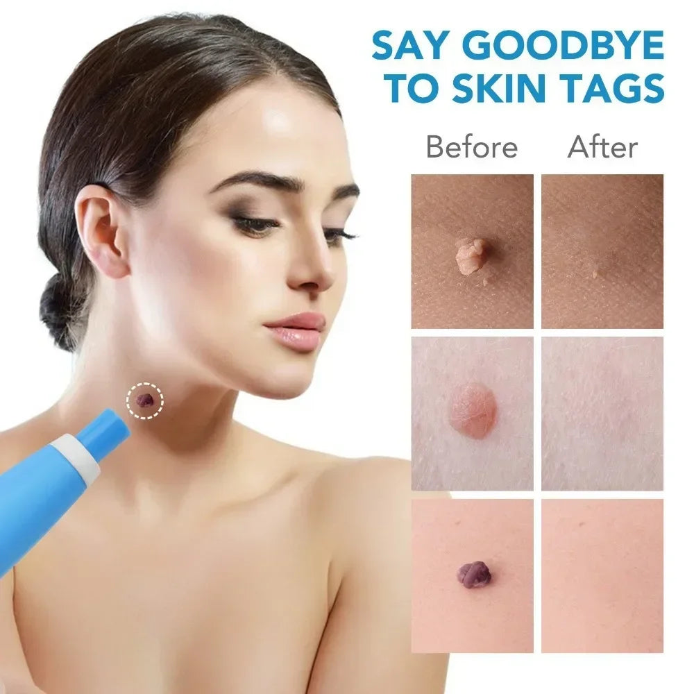2-In-1 Painless Auto Skin Tag Mole Wart Removal Kit
